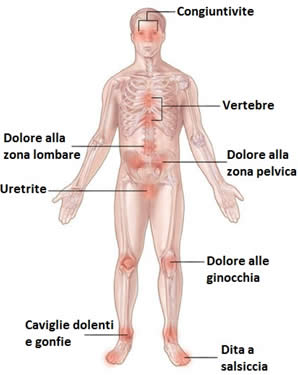 sindrome-di-reiter