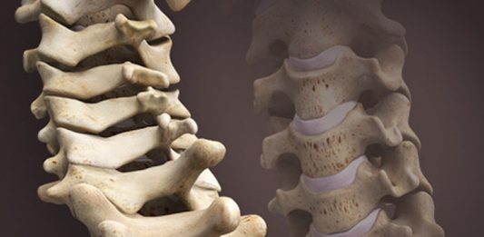 disco intervertebrale