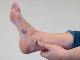 Ottawa Ankle Rules: escludere fratture nelle distorsioni