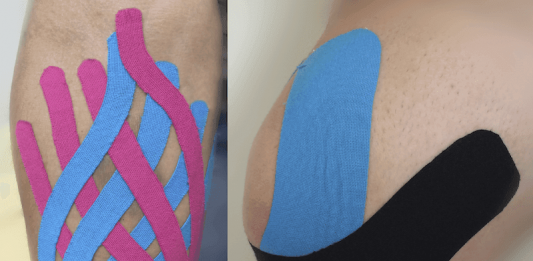 Taping elastico: funziona o è solo una moda? taping elastico