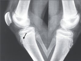 osgood schlatter